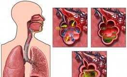 neumonia