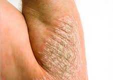 psoriais1