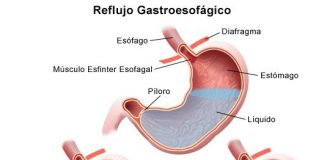 regurgitacion