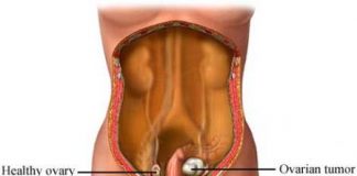 tumor_ovarico1