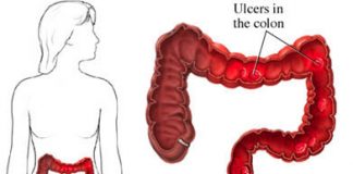 colitis1