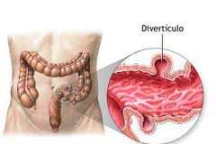 diverticulosis
