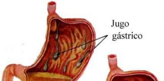 jugogastrico1