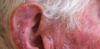 queratosis-actinica1