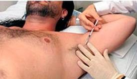 Botox-para-la-transpiracion