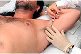 Botox-para-la-transpiracion