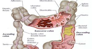 Limpieza-intestinal1