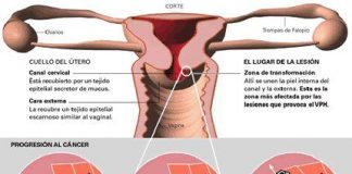 cancercervicouterinio