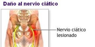 ciatica-2