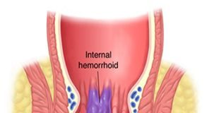henorroides-tratamiento1