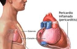 Cardiopatia-isquemica