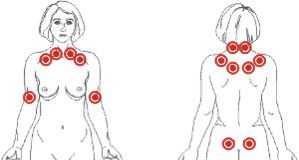 fibromialgia1