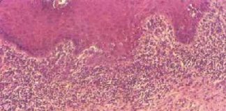 liquenplano1