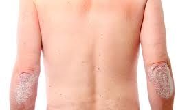 psoriasis1