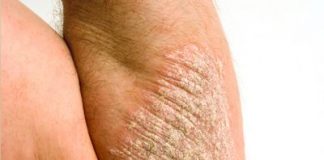 psoriasis2