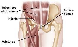 pubalgia-3