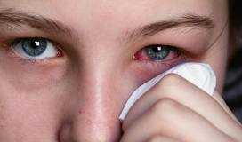 conjuntivitis