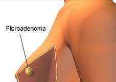fibroadenoma