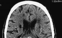 infartos-cerebrales