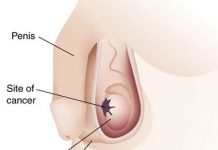Quistes testiculares quistes-testiculos