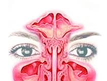 rinitis-2