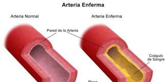 aterosclerosis