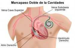 desfibrilador-2