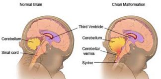 malformacion-de-Arnold-Chiari