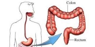 terapia-colonica