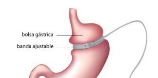Complicaciones-a-tener-en-cuenta-con-las-bandas-gastricas