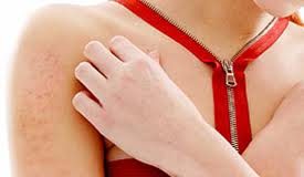 dermatitis-atopoca