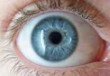 glaucoma