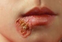 impetigo