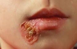 impetigo