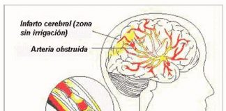 infarto-cerebral