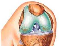 artrosis-rodilla-1