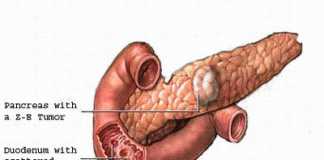 sindrome-de-zollinger-ellison