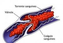 Un nuevo procedimiento podría ayudar a los pacientes con trombosis venosa profunda trombosisvenosa