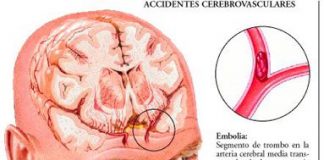 accidente-cerebrovascular