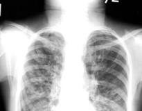 fibrosis-pulmonar-idiopatica