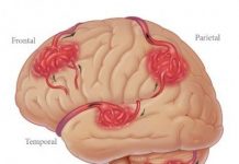 Las hemorragias cerebrales son más comunes en fumadores hemorragias-cerebrales-en-fumadores