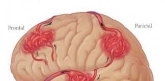 hemorragias-cerebrales-en-fumadores