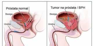Incidencia-del-cancer-de-prostata-a-nivel-mundial