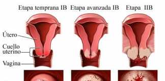 cancerutero