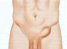 Causas-y-acciones-que-produce-la-hernia-de-ingle-en-nuestra-salud