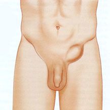 Causas-y-acciones-que-produce-la-hernia-de-ingle-en-nuestra-salud
