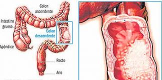 Generalidades-de-la-presencia-de-un-cancer-de-intestino