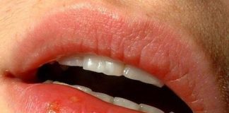 Remedios-naturales-para-combatir-el-herpes-labial
