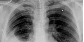 Sintomas-y-tratamiento-del-derrame-pleural