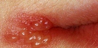 Tipo-de-herpes-que-puede-presentarse-en-nuestro-cuerpo-y-organismo